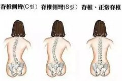 孩子脊椎變形的原因您知道多少？